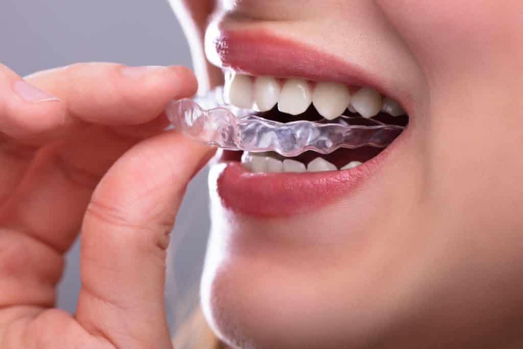 Close-up,Of,A,Woman's,Hand,Putting,Transparent,Aligner,In,Teeth